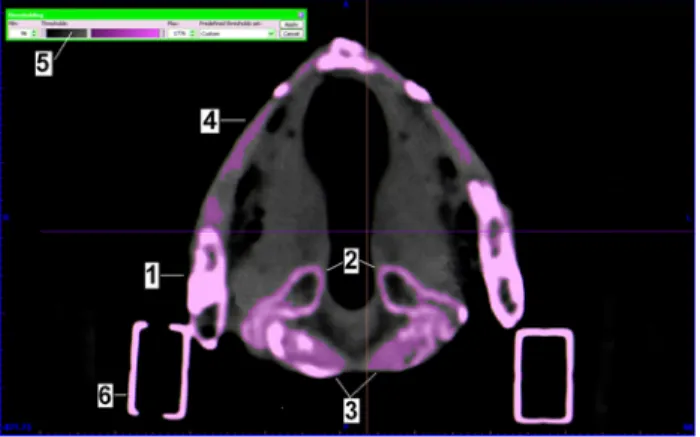 Fig. 3 3D-rendered male  cadaver larynx (a) and patient’s  larynx (b). All relevant  anatomi-cal structures and landmarks can  be visualised in both 3D images  (1: thyroid cartilage; 2: cricoid  cartilage; 3: arytenoid cartilages; 