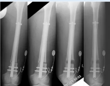 Abb. 2  8  Radiologische Verlaufsaufnahmen während der Distraktion. 