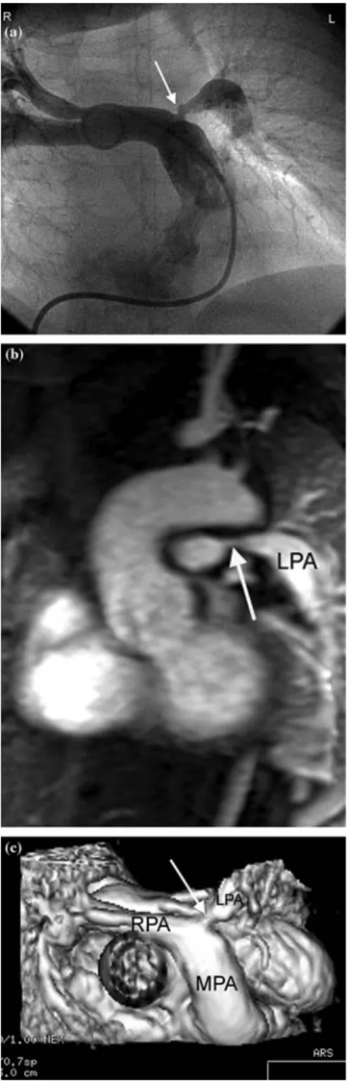 Figure 1. Severe Stenosis of the left pulmonary artery as dem- dem-onstrated by XRA (a) and by CE-MRA with the multi intensity projection reconstruction (b) and in the 3D reconstruction (c).