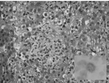 Fig. 1 Non-caseating epitheloid cell granuloma in a hepatic lobule characteristic of CMV hepatitis in an immunocompetent host (hematoxylin and eosin staining); focally positive nuclear  early-antigen immunostaining in a hepatocyte (inset)