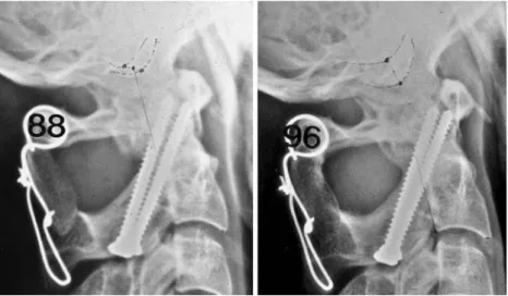 Fig. 3 Solid atlantoaxial fusion using the transarticular screw ﬁxation technique