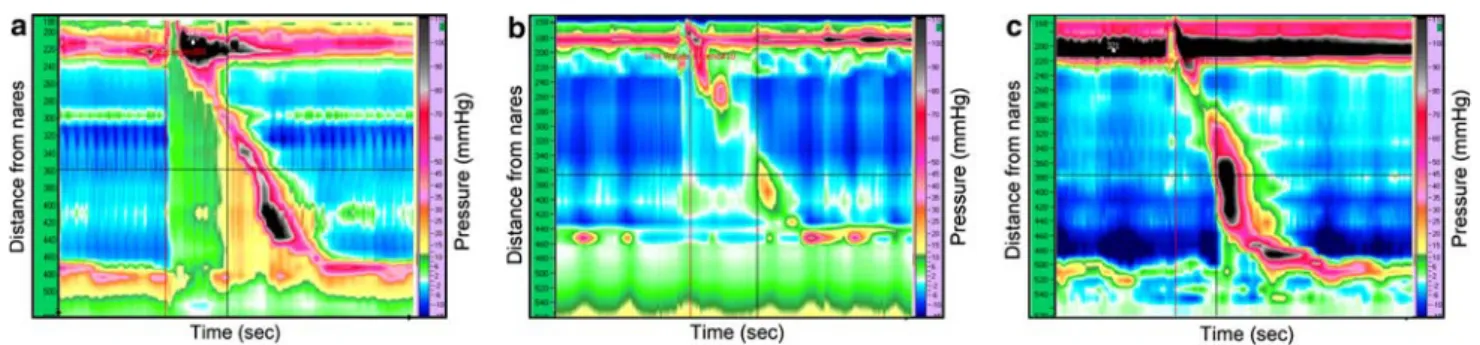Fig. 1 Examples of normal (a), ineffective (b), and simultaneous (c) contractions during a 10 ml water swallow on a 32-channel  high-resolution manometry (HRM) tracing