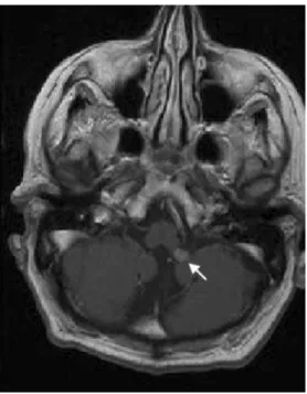 Fig. 2 Contrast-enhanced, T1-weighted axial MRI of the brain showed a small, homogeneously enhancing lesion at the left foramen of Luschka