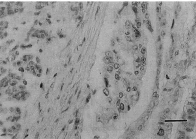 Fig.  1. MIB-I  immunostaining in a moderately differentiated pancreatic cancer (bar  I00  lam)