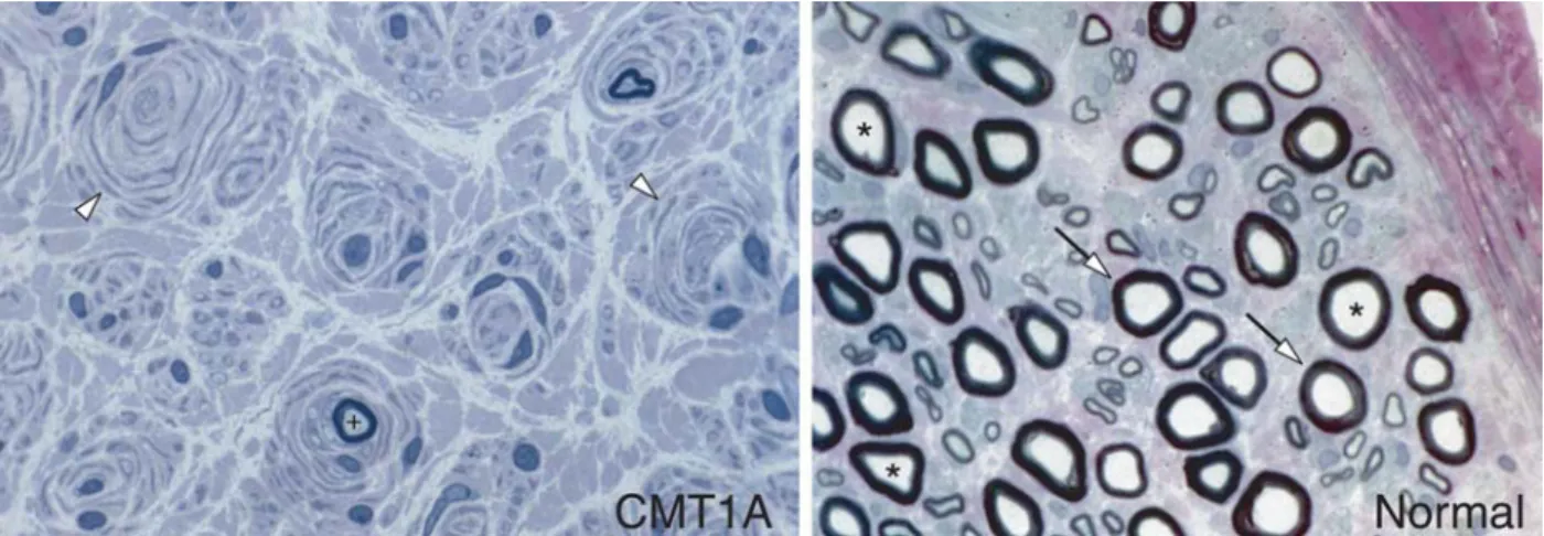 Figure 1. Histopathological comparison of a normal human sural nerve and a nerve from a CMT1A patient