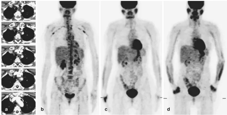 Fig. 4. a The abdominal and thoracic CT scan of a 52-year-old woman with rheumatoid arthritis, fever, night sweating and loss of weight showed no abnormalities
