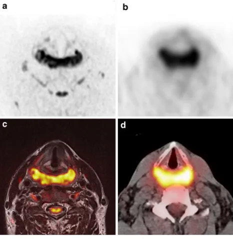 Fig. 1 Anatomically matched corresponding transverse slices of inverted b1000 (a), PET (b), fused T2-weighted, b1000 (c) and fused PET/CT (d) images of a 63-year-old male with primary squamous cell carcinoma of the hypopharynx staged T4a N2c M0