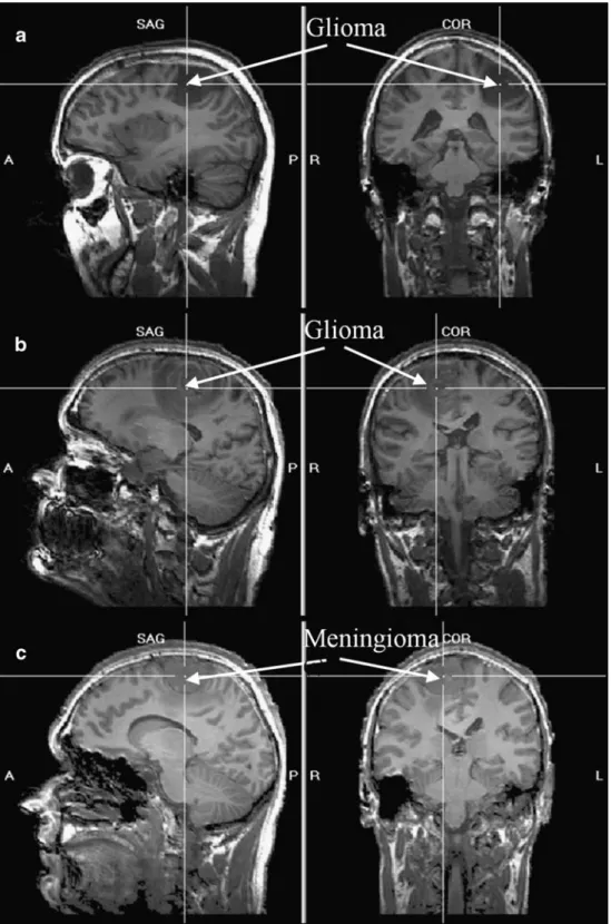 Fig. 1 Localization of the tumors (indicated by the white cross-hairs and white arrows) on sagittal (left column) and coronal (right column) slices.