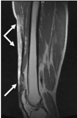 Fig. 2 Sagittal section through the affected thigh one and a half years after the first attempted repair
