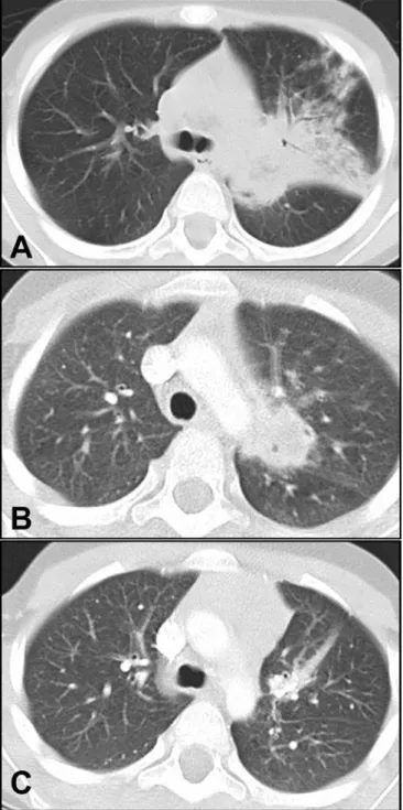 Fig. 1 HRCT of the lung. A Extensive left upper lobe inﬁltration on day 10. B A left hilar pulmonary abscess with inclusions of air (day 76)