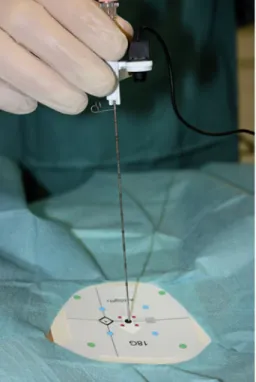 Fig. 2 A CT control after carefully advancing the needle through the S1- neuroforamen after application of a minimal amount of local anesthesia at the dorsal ostium to avoid nerve root block