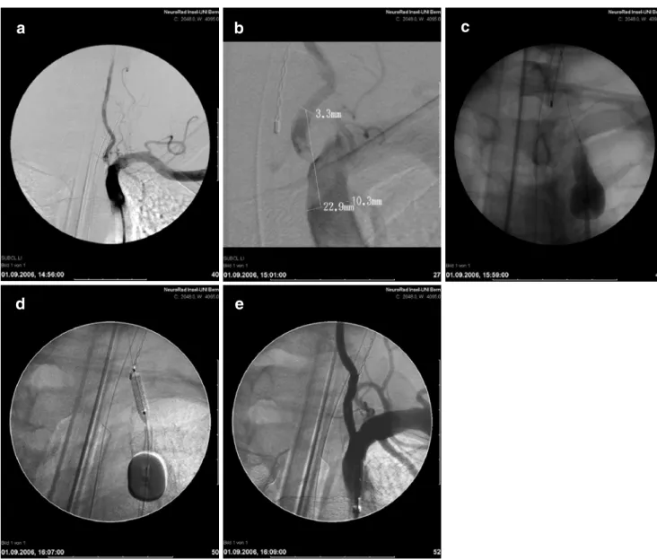 Fig. 4 Proximal protection device (Mono-MOMA). 57-year-old woman with acute vertebrobasilar symptoms