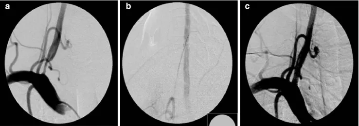 Fig. 5 Distal protection device (FilterWire). A 42-year-old man suffering from recurrent symptoms of vertebrobasilar insufficiency.