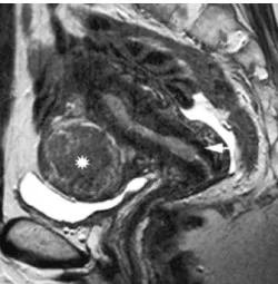 Fig. 4 Sagittal T2-weighted image of the uterus in a 60-year-old patient with grade 2 endometrial carcinoma