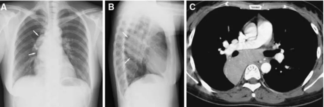 Fig. 2. Angiography prior to and following embolization. (A) Arterial phase of aortography shows the hypervascular mediastinal mass with two feeding arteries coming from a  broncho-intercostal trunk: a superior and lateral branch (black arrow) and an infer