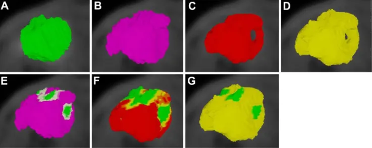 Fig. 5 Three-dimensional volume rendering of the gross tumor volumes (GTVs) assessed using the various segmentation techniques and overlap analysis of the geographic match/mismatch between the defined GTVs