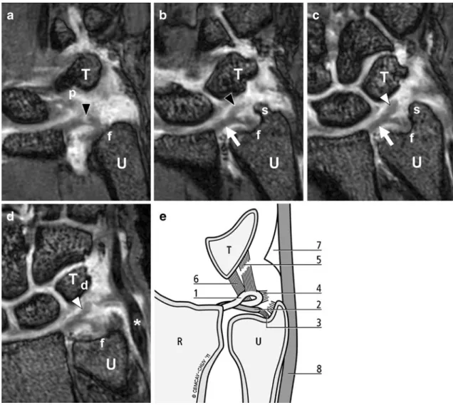 Fig. 1 a – d Left to right: sequential (palmar to dorsal) coronal T1- T1-weighted (repetition time/echo time, 11.2 ms/3.5 ms) custom volumetric interpolated breathhold examination (VIBE) MR  arthro-graphic images of the right wrist display partial separati