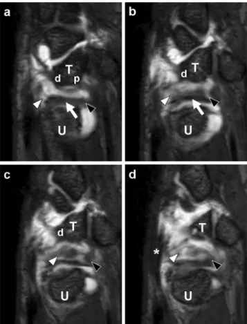 Fig. 2 a – d Left to right: sequential (radial to ulnar) sagittal reformatted T1-weighted (repetition time/echo time, 11.2 ms/3.5 ms) custom volumetric interpolated breathhold examination (VIBE) MR arthrographic images of the right wrist show partial separ