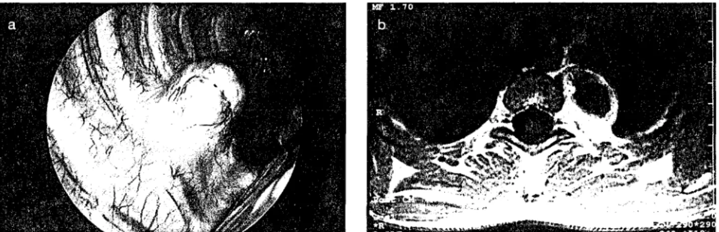 Fig.  3.  Resection o f  a neurogenic  tumor by use o f  VA'I S in an adult patient ( a ), after exclusion  q f  extensio~  within the spilzal channel  (dumbbell tu-  mor)  by  use  o['a pre-operative  M R I   (b)