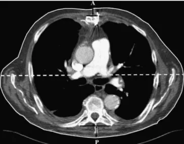 Fig. 1 Transverse CT image (5 mm thick) at the level of the main pulmonary artery demonstrating the morphologic measurements used in the study