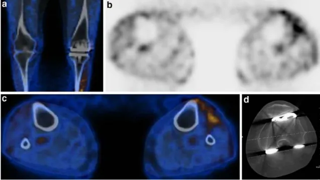 Fig. 2. Coronal PET-CT (a), axial PET (b), axial PET/CT (c) and CT measurement of component rotation (d) in a 66-year-old woman with diffuse pain