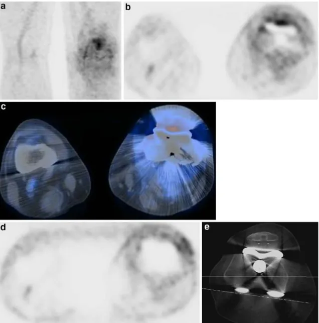 Fig. 4. Maximum intensity projection (MIP) PET (a), axial attenuation-corrected PET (b), axial PET/CT (c), axial  non-attenu-ation-corrected PET (d) and CT measurement of component rotation (e) in a 55-year old man with infection of the left knee replaceme