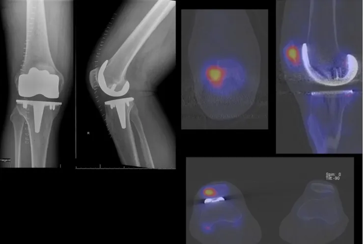 Fig. 3 Clinical example of a patient with persistent pain 1 year after total knee arthroplasty