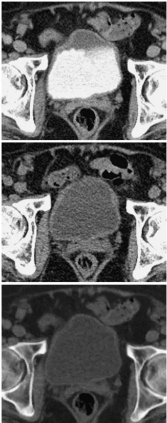 Fig. 2. A Transverse contrast-enhanced weighted-average dual-energy CT, true nonenhanced (TNEI) single-energy CT (B), and virtual nonenhanced (VNEI) dual-energy CT (C) images in a 70-year-old woman with unclear hematuria examined by tube voltage setting B 
