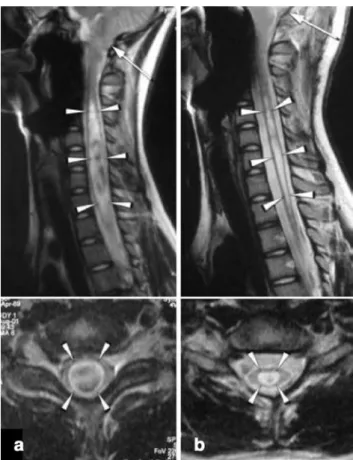 Fig. 2 a Preoperative sagittal and axial T2-weighted magnetic res- res-onance imaging (MRI) demonstrates a Chiari malformation type 1 with a large cervical syringomyelia (arrowheads) extending from C2 to T1