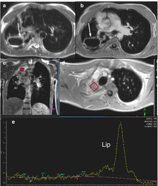 Fig. 1 Case 1: Axial T2 (a) and axial contrast-enhanced  T1-weighted (b) MR images reveal a large pulmonary cavern in the right posterior upper lobe (white arrow)