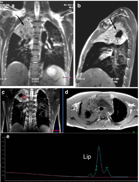 Fig. 2 Case 2: Coronal (a), sagittal (b) T2-weighted, and axial T1-weighted (d) MR images reveal a large  pulmo-nary cavern in the apex of the right upper lobe within a large consolidation (black arrow in a, b)