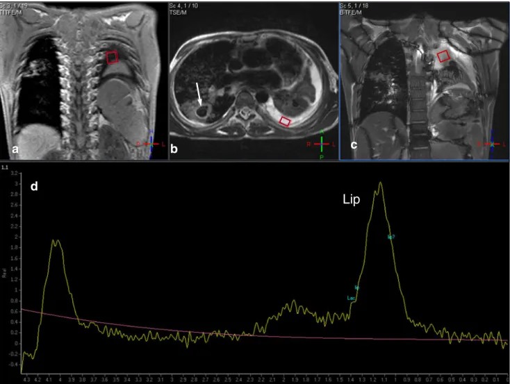 Fig. 3 Case 3: Coronal T1 (a), axial (b), and coronal (c) T2-weighted images show a cavern in the right lung (white arrow in b) and the atelectatic left lung and large pleural effusion on the left (black arrow).