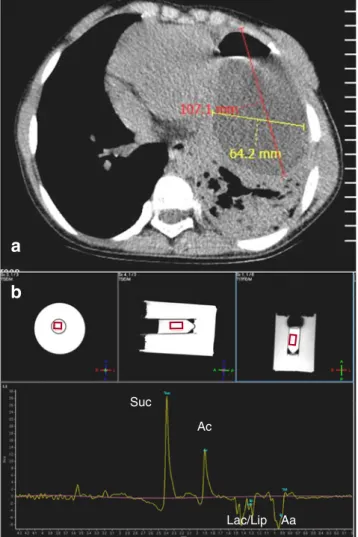 Fig. 4 Case 4: Axial CT (a) showing an abscess in the lower left lobe.