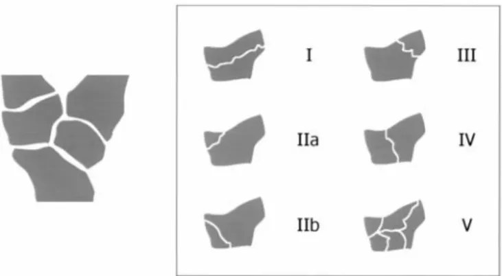 Fig. 1 Classification of trapezium body fractures as proposed by Walker et al. [12]