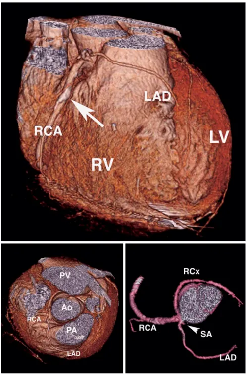 Fig. 2. Three-dimensional reconstructions (volume rendering) based on the isotropic multislice computed tomography angiography data set clarify the relation between the abnormal origin and the course of the coronary arteries and the surrounding structures 