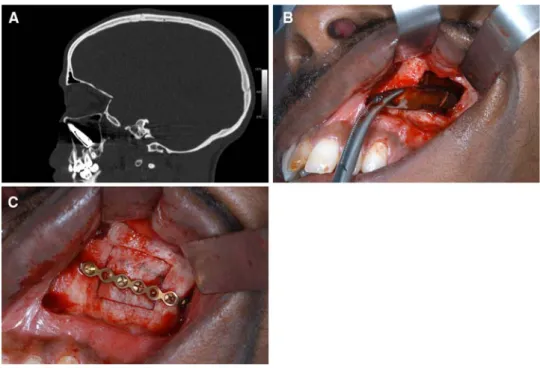 Fig. 1 Patient 1: a Preoperative sagittal CT-scan images revealing the bullet within the left maxillary sinus