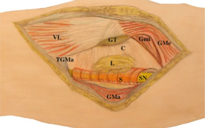 Fig. 3 Drawing of the operation situs: Behind the greater trochanter (GT), a 4 9 3 9 2 cm lipoma (L) covers a tight fibrous scar (S) enclosing the sciatic nerve (SN)
