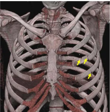 Fig. 2 MSCT, 3D bone reconstruction of the chest of a young woman stabbed 13 times into the left side of her chest by her flatmate