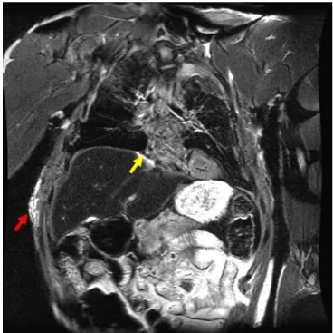 Fig. 9 Coronal T2-weighted SE sequence (TE 98 ms/TR 4,000 ms) of the trunk of a traffic accident victim