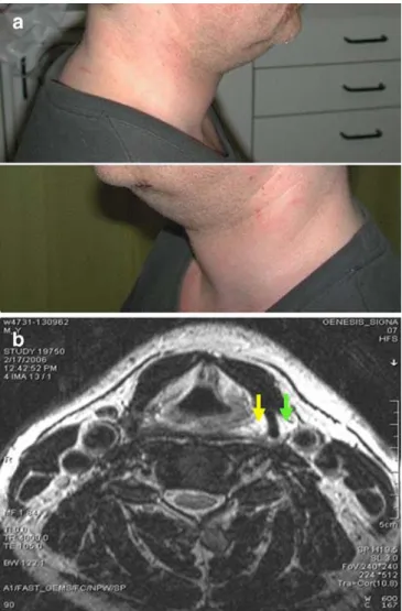 Fig. 11 Coronal reformation of MSCT scan after suicidal gunshot to the right temple (a) and corresponding coronal T1-weighted MRI (b)