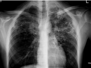 Abb. 1  7  Typisches   Oberlappeninfil-trat bei pulmonaler   Tuberkulose