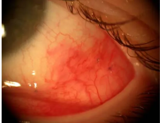 Fig. 2 Photographs of a 15-year-old girl with strabismus sursoad- sursoad-ductorius 24 hours after a 13 mm recession of the left inferior obliquus muscle