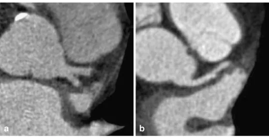 Figure 3 shows examples of coronary artery opacifica- opacifica-tion in two patients with high and low CO.