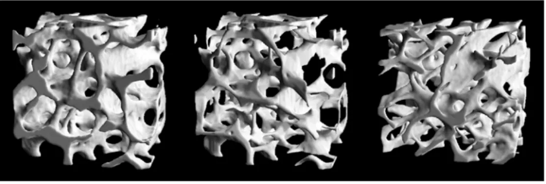 Fig. 1 Three-dimensional trabecular bone architecture of iliac crest bone biopsies of a 32-year-old (left), the corresponding  ‘‘80-year-old’’ simulation (middle) and an 83-year-old (right) woman, respectively
