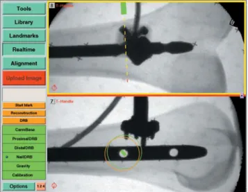 Figure 2. Example of navigational feedback. In this case of CT-based navigation during pedicle screw placement, the optimal location for the screw in L2 has been planned preoperatively (red line)