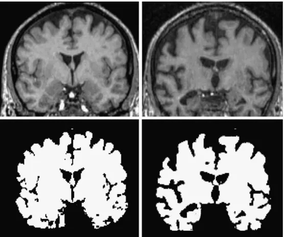 Fig. 2 Brain atrophy as struc- struc-tural biomarker in AD. The rate of brain volume reduction is significantly higher in patients suffering from AD as compared to age-matched healthy persons.