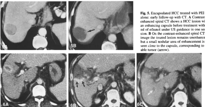 Fig. 5.  Encapsulated HCC  treated with PEI  alone: early follow-up with CT.  A  Contrast-  enhanced spiral CT  shows a  HCC  lesion with  an enhancing capsule before treatment with 40  ml  of ethanol under US  guidance in  one  ses-  sion
