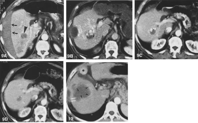 Fig. 9. Long-term follow-up after PEI of a small HCC in a noncirrhotic liver. A Contrast-enhanced spiral CT image shows a 3-cm HCC in the  right lobe of a noncirrhotic liver (arrowhead)