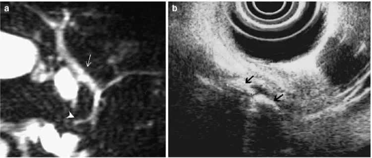 Fig. 5 An 82-year-old woman, known for deafness and senile dementia, with acute pancreatitis of suspected biliary origin and associated cholangitis