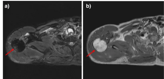 Fig. 3 Internal injuries of the humerus of a pedestrian who was hit by a car whilst kneeling on the ground (case 2).